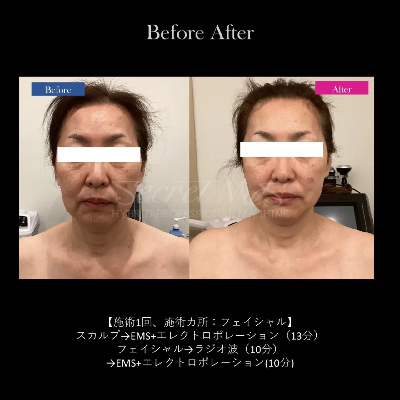 【フェイシャル Before → After ✨】